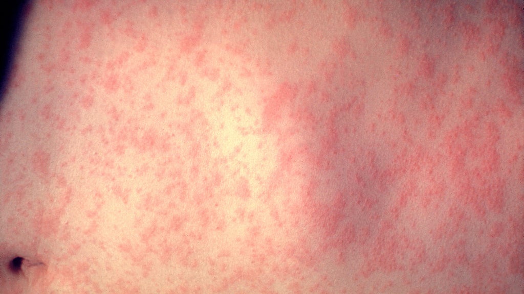 25 cases of measles identified in central, southeastern Minnesota, MDH says — WCCO / CBS Minnesota, Excelsior Health news